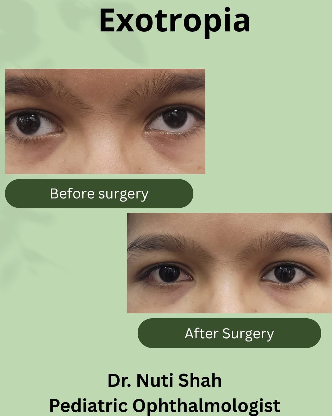 Exotropia paediatric outcome
