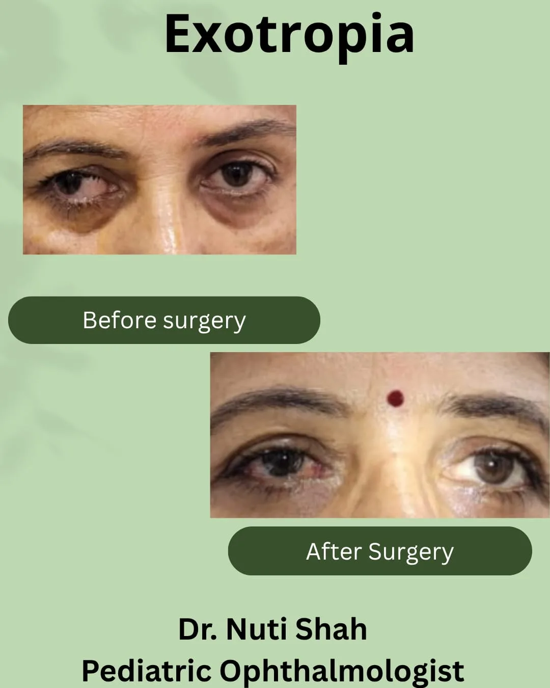 Adult exotropia squint correction result