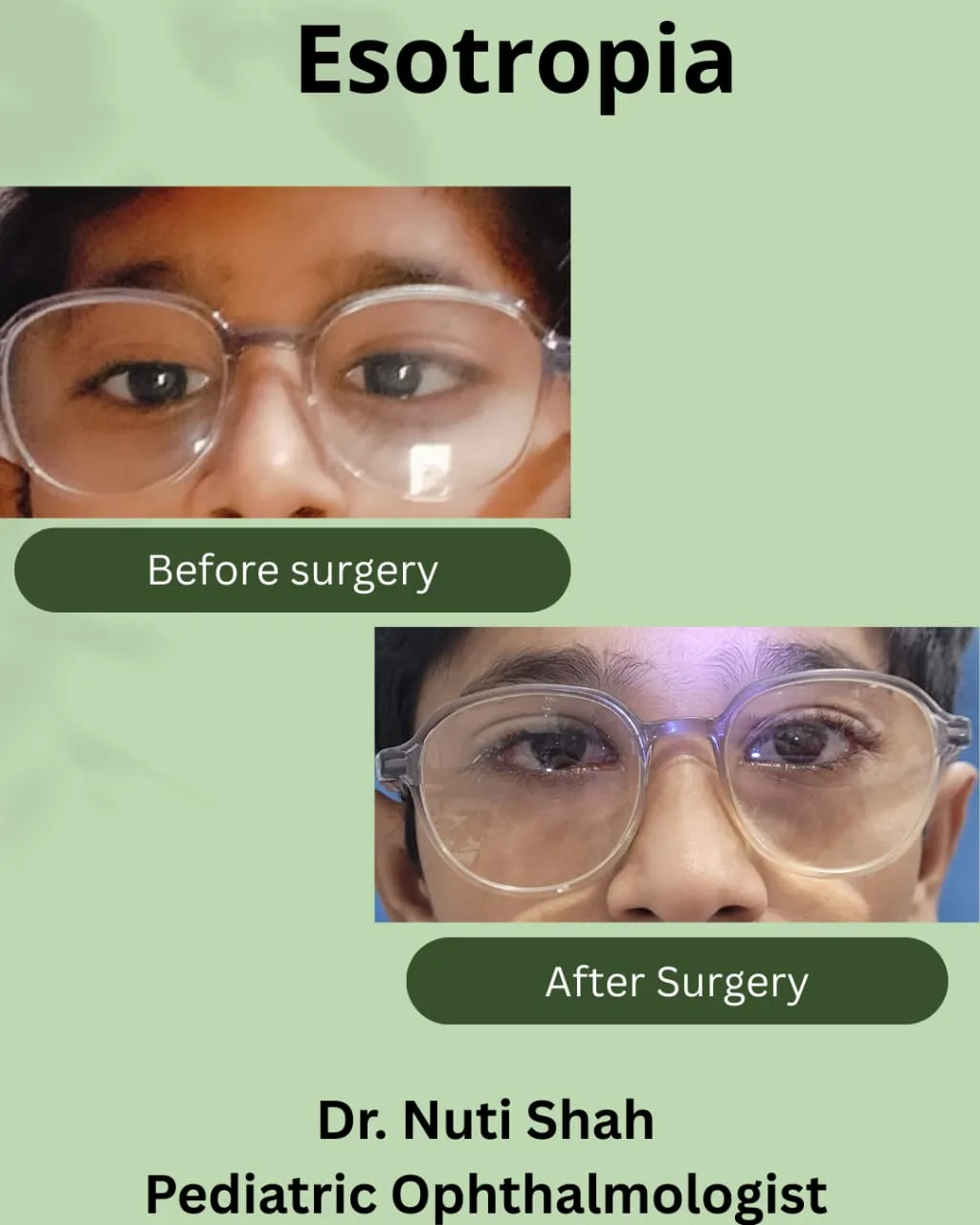 Esotropia squint treatment in a child