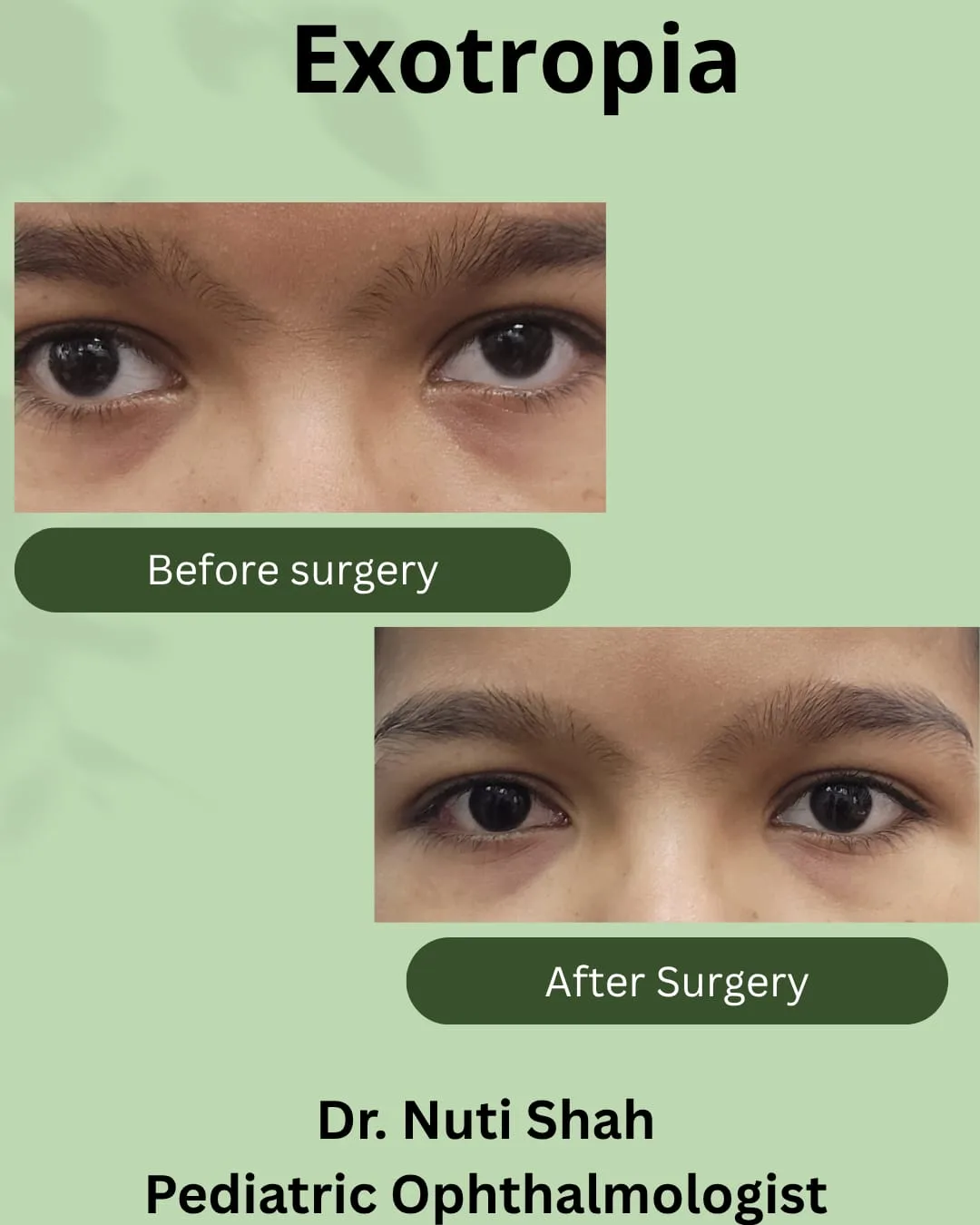 Paediatric exotropia squint surgery outcome